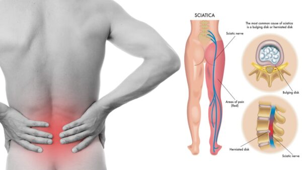 Sciatica Pain Kit - Image 4