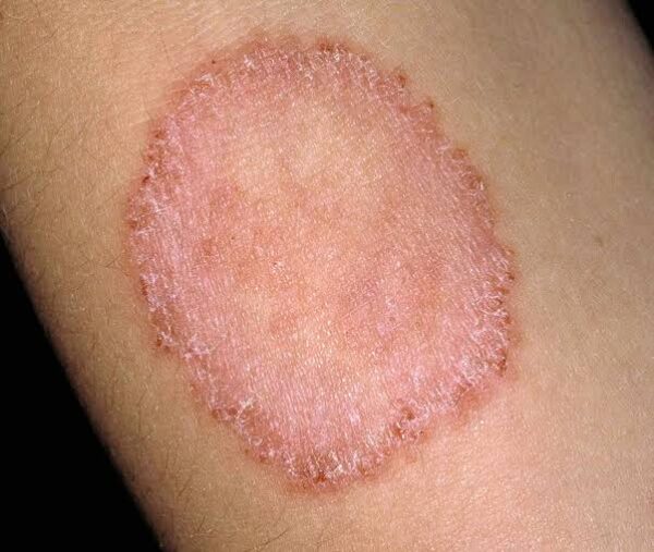 Ringworm Fungal Cream - Image 2